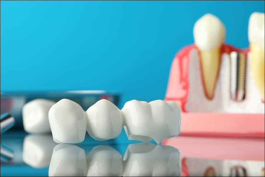 Dental Bridges