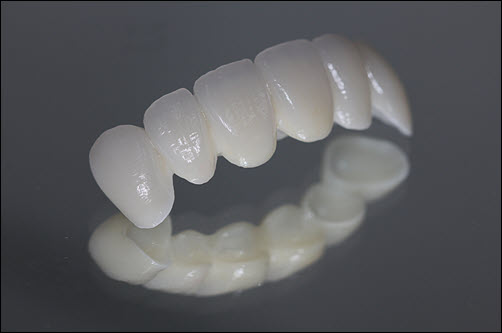 Dental Bridges
