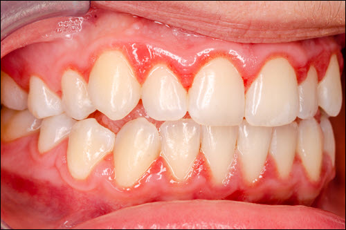 Gingivitis