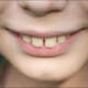 Overbite
