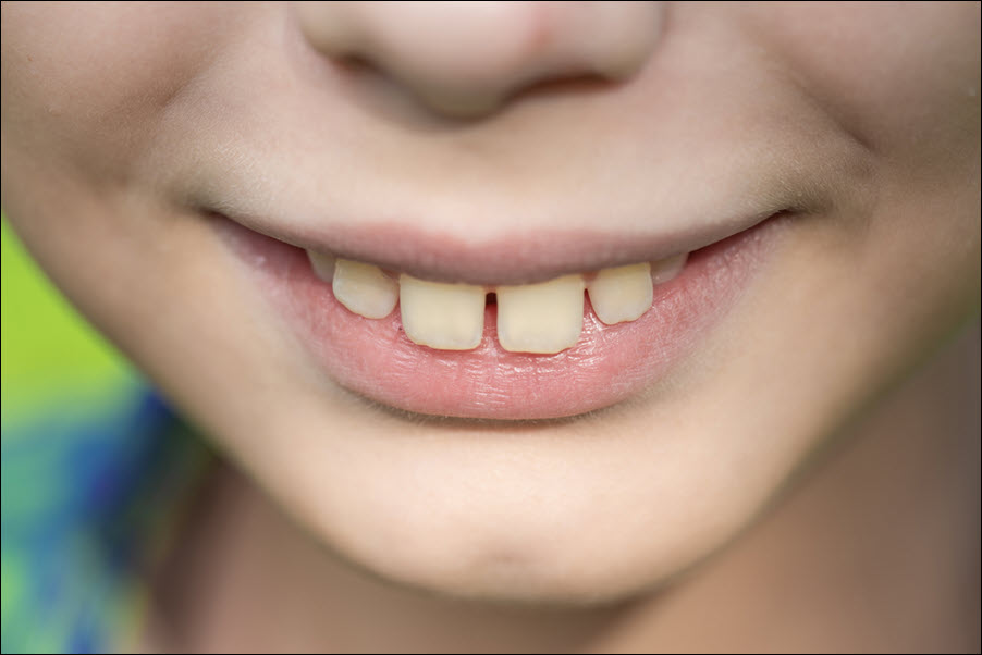 Overbite