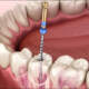 Root Canal Therapy