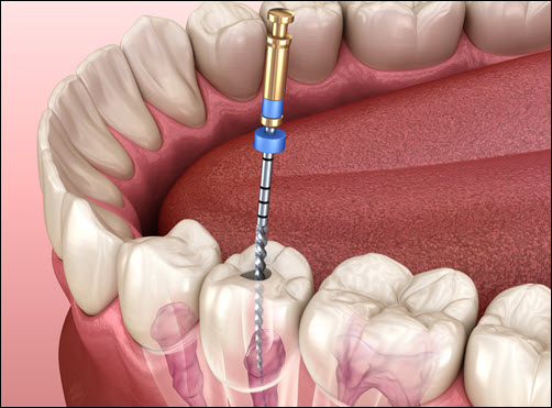 Root Canal Therapy