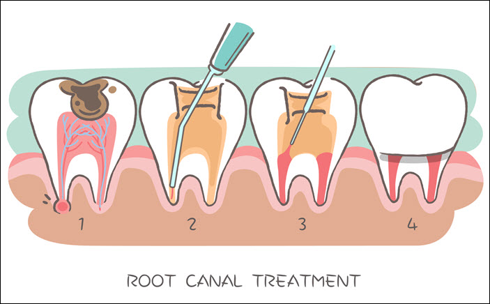 Root Canal Therapy